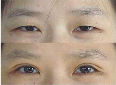 如何选择适合自己的双眼皮形状