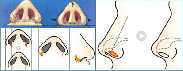 鼻翼缩小