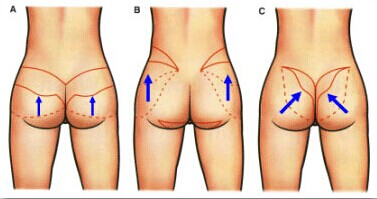 提升塑臀术