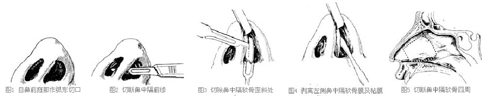 歪鼻矫正