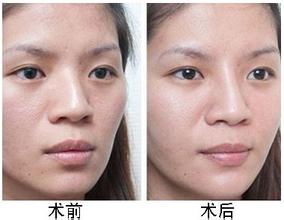 杭州格莱美专家提示那些鼻子适合做隆鼻