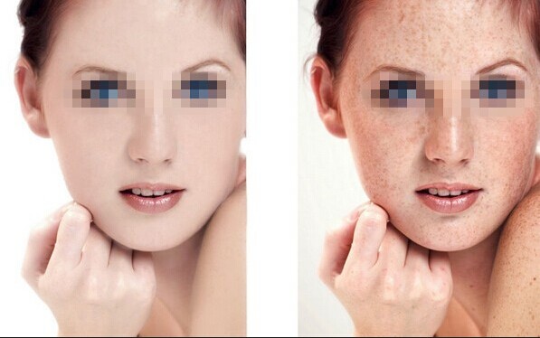 激光去晒斑对皮肤有没有伤害呢?