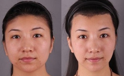 做去颊脂垫瘦脸手术的的过程是怎么样的呢？