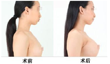 煤炭总医院整形科王英勇做假体隆胸怎么样?