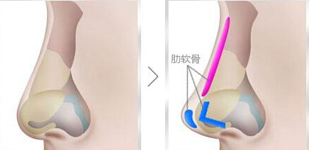 假体隆鼻多少钱