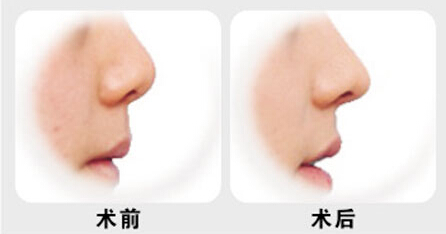 上海做鼻子应该去哪里好呀?有在上海做的吗?