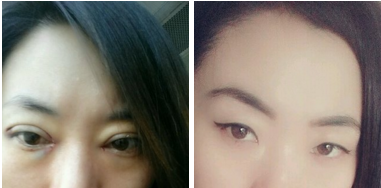 兰州刘萍+整形项目:做双眼皮好美呀
