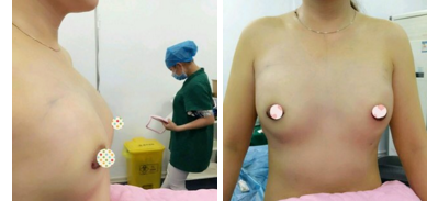 台州假体隆胸术要多少钱