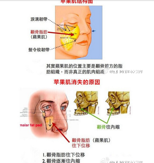 如何区分苹果肌和高颧骨，看图说话