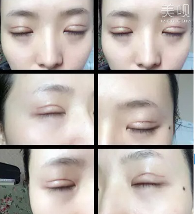 案例|做双眼皮一年恢复过程图分享
