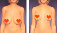 乳头整形你知道多少