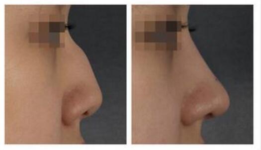 驼峰鼻怎么办，可以做驼峰鼻矫正手术吗？