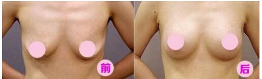 广州市第二人民医院做乳房下垂矫正好不好?