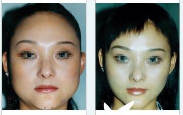 北京东方和谐下颌角整形*果好吗