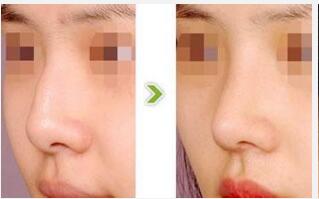 驼峰鼻矫正的方法有哪些?