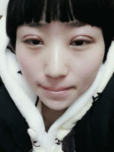 上海华美叶丽萍做的双眼皮手术快两个月了 恢复的不错哦