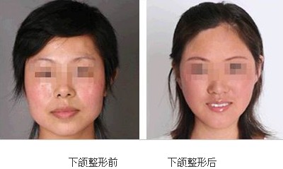 石家庄哪家下颌角整形医院好?