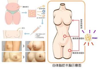 北京八大处整形隆胸好不好，价格表？