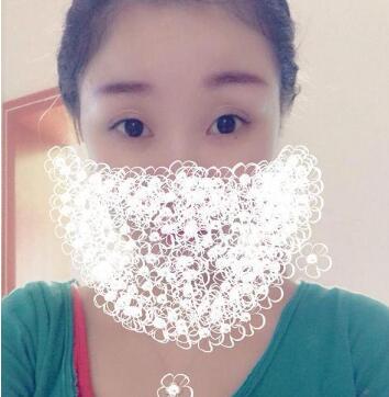 成都唯罗纳医疗美容门诊部夏正义医生双眼皮案例?