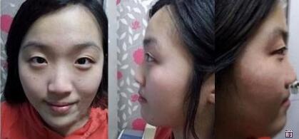 广州博仕整形门诊部秦继峰医生割双眼皮案例?