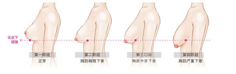 乳房下垂矫正术适宜人群有哪些?到底是什么原因致使乳房下垂的呢