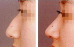 驼峰鼻矫正的方法有哪些