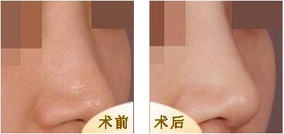 韩式隆鼻手术不同与传统隆鼻手术,