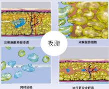 北京延世整形能做大腿吸