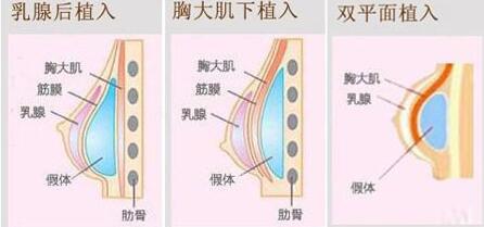 十大隆胸整形医院-美人苑整形网介绍