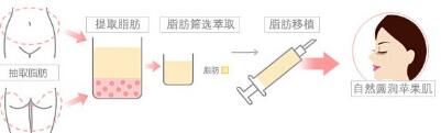 丰苹果肌的适宜人群