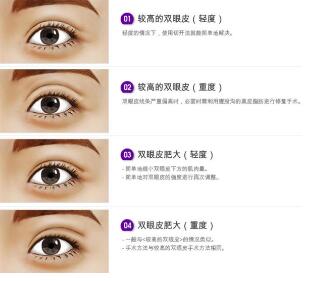 深圳鹏程整形医院口碑怎么样？眼部整形贵不贵