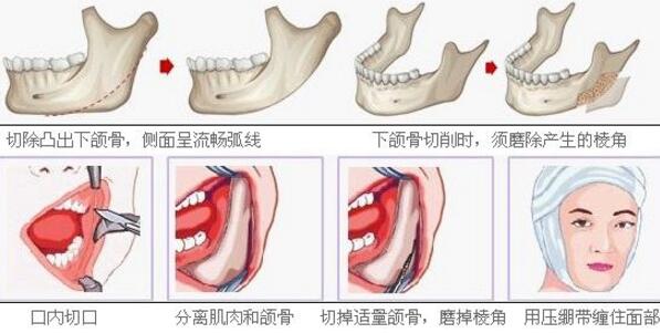 下颌角切除手术帮你改善脸型秒变瓜子脸