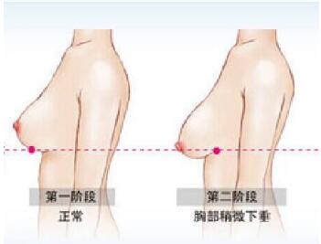 北京做自体脂肪丰胸大概多少钱