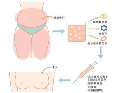 韩国做假体隆胸*果好不好