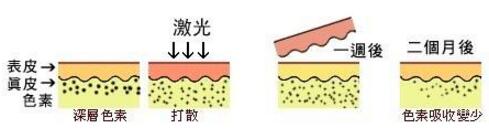 大连艺星激光祛斑怎么样