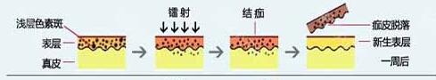 杭州市第三人民医院祛斑哪个专家*果好