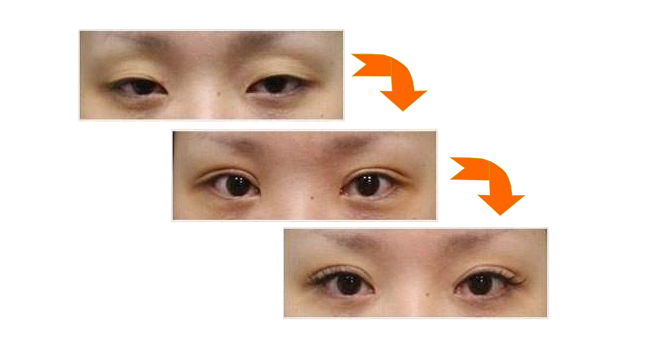 济南中心医院张医生处做的双眼皮、内眼角、祛眼袋案例