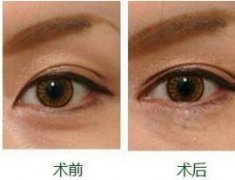 北京开眼角的费用高吗
