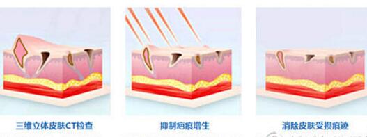 重庆骑士医院疤痕科陈祥勇专家祛疤案例
