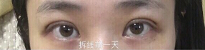南京妇幼保健院高艳丽医生做双眼皮手术*果怎么样?