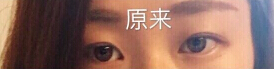南京妇幼保健院高艳丽医生做双眼皮手术*果怎么样?