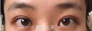 南京妇幼保健院高艳丽医生做双眼皮手术*果怎么样?