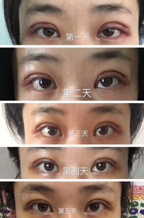 南京妇幼保健院高艳丽医生做双眼皮手术*果怎么样?