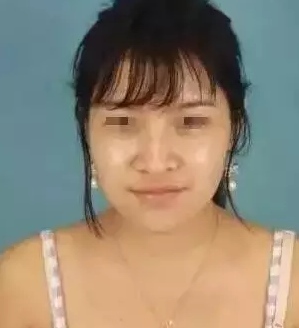 新疆芙蓉医美做的隆鼻垫下巴手术案例