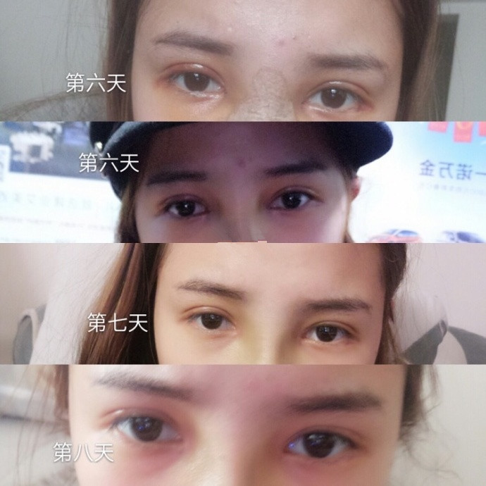郑州都市风韵贾亮亮医生做的全切双眼皮案例?