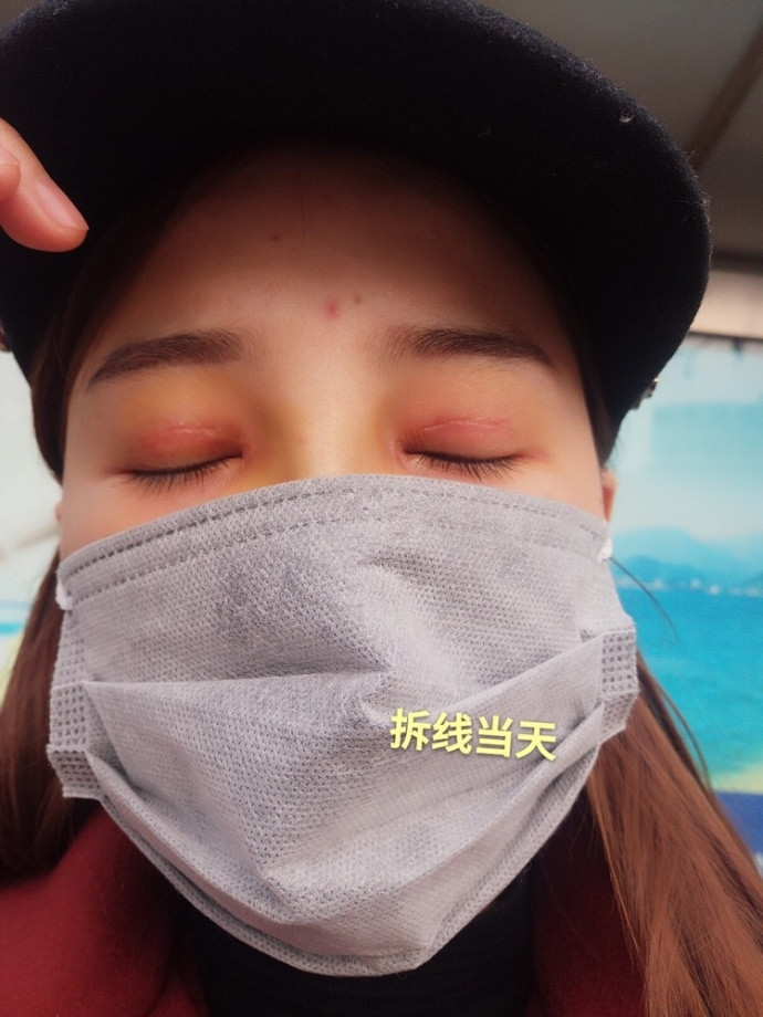 郑州都市风韵贾亮亮医生做的全切双眼皮案例?