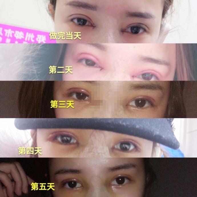 郑州都市风韵贾亮亮医生做的全切双眼皮案例?