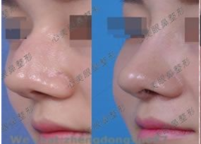 韩国鼻整形专家郑东学在哪个医院 做鼻子多少钱