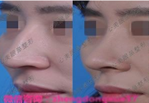 韩国鼻整形专家郑东学在哪个医院 做鼻子多少钱