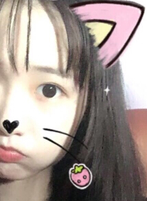 吕方中医生双眼皮手术案例
